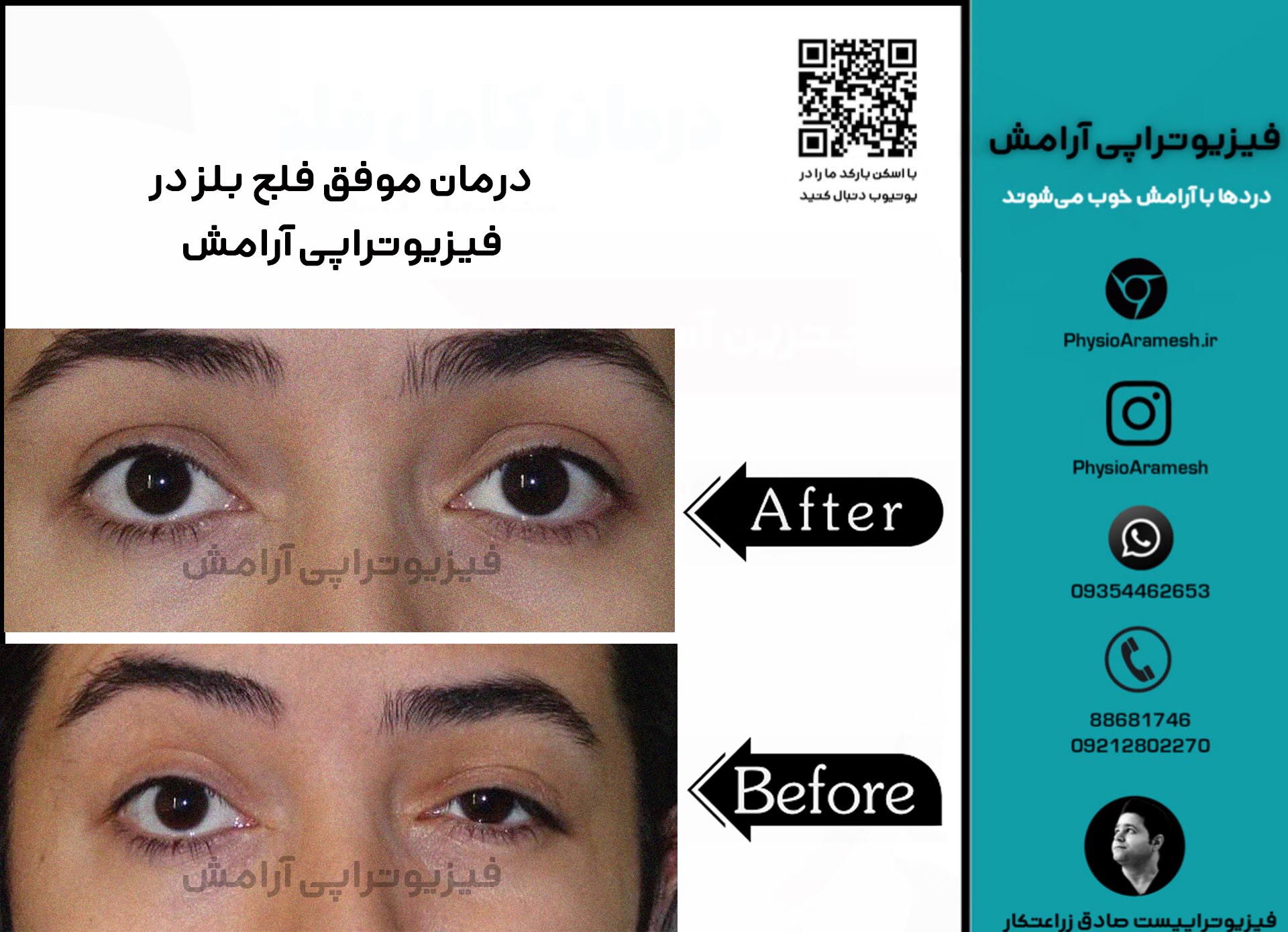 درمان موفق فلج بلز